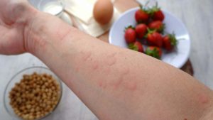 آلرژی غذایی